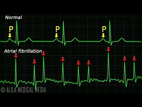 心房纖維性顫動大解密 (Atrial Fibrillation Anatomy, ECG and Stroke, Animation)
